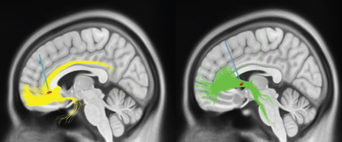 Side-by-side brain scans with electrodes marked by a blue line and red dot and white matter tracks visible in yellow on the left and in green on the right.
