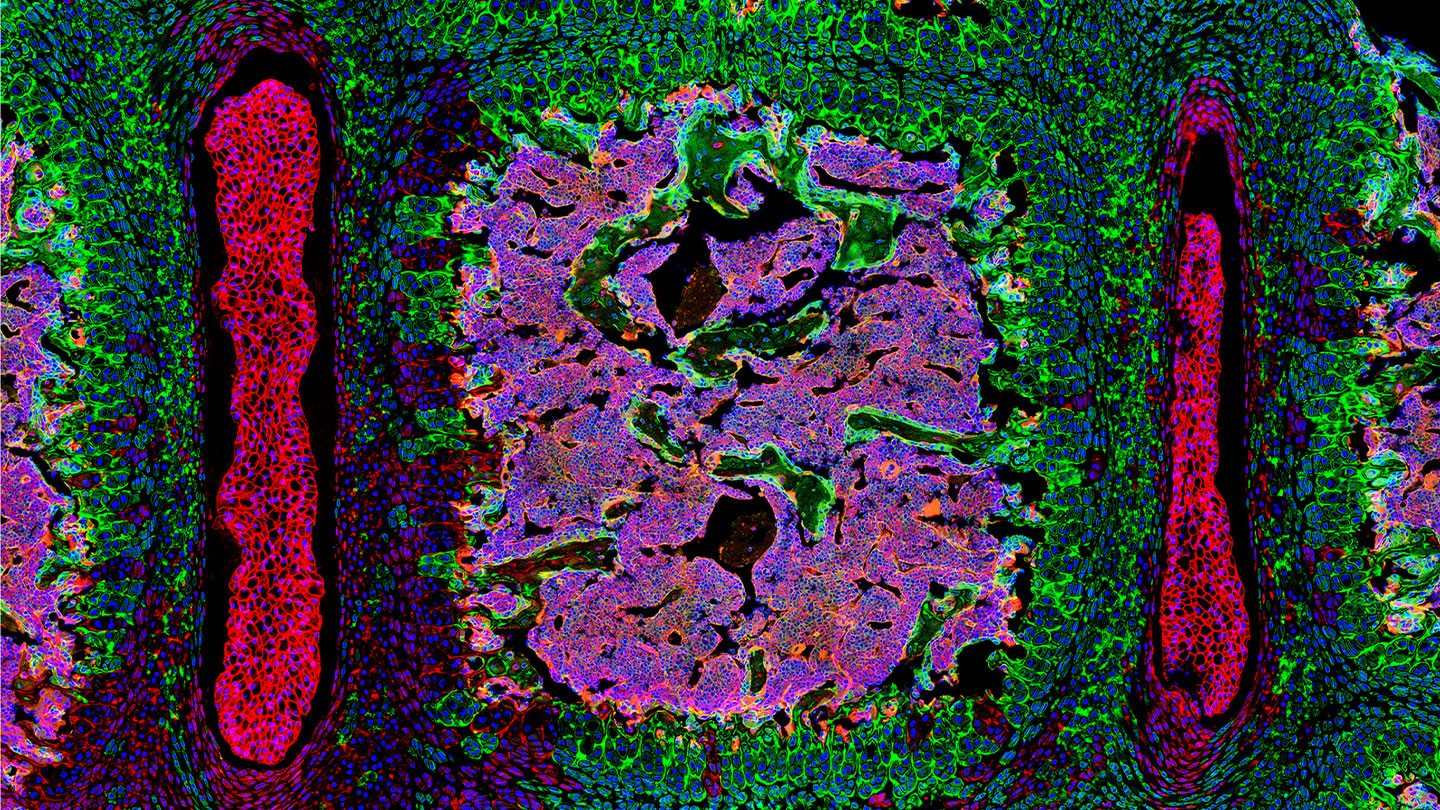 Breast cancer can spread to the spine. Scientists may now know why