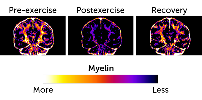An image showing three MRI scans in a row from a marathon runner. The image on the left shows a human brain and its myelin level pre-exercise, there are shades of yellow, orange, red, and purple. The scan in the middle shows a brain postexercise with only purple visible. The scan on the right shows a brain in recovery where the colors match that seen pre-exercise.