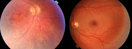 Gene therapy restores limited vision in three people with an inherited form of blindness. Studies in mice indicate that other cells in the retina can take over for rod and cone cells.