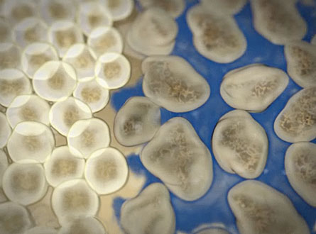 In nanomagnetic cancer treatment, blue fluid with therapeutic nanomagnets targets tumor cells (right). But the nanomagnets leave healthy cells (left) alone.