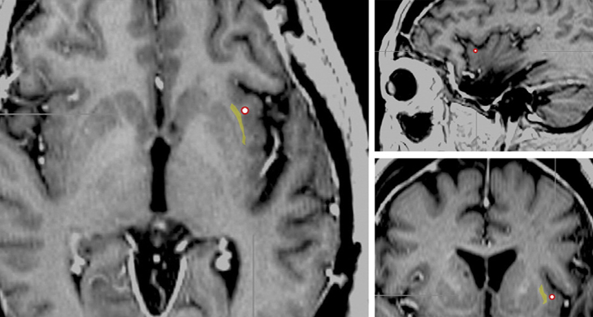 brain scans of epileptic woman