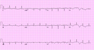 lines of an electrocardiogram