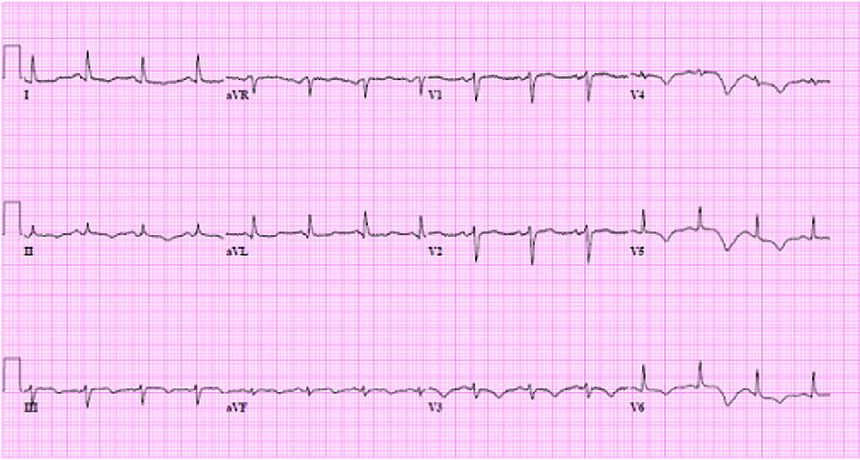 lines of an electrocardiogram