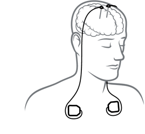illustration of deep brain stimulation