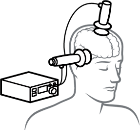 illustration of electroconvulsive therapy