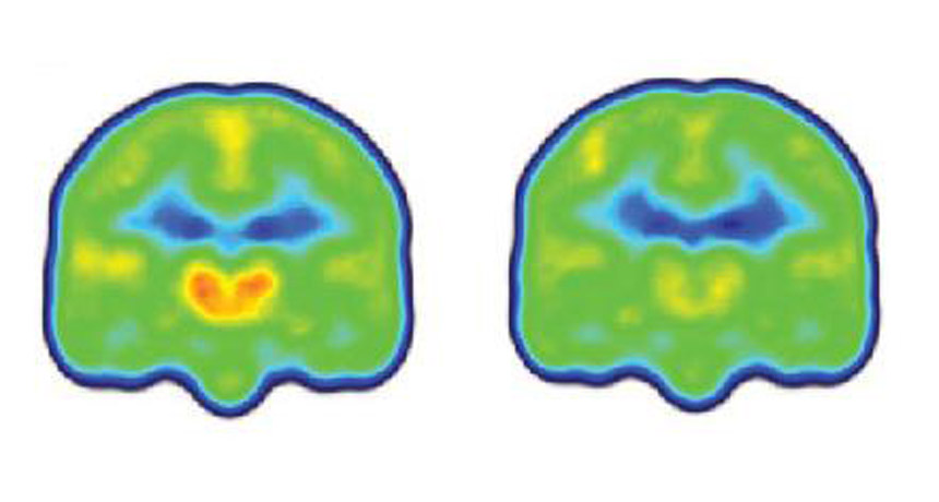 PET and MRI brain scans