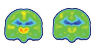 chronic pain protein builds up