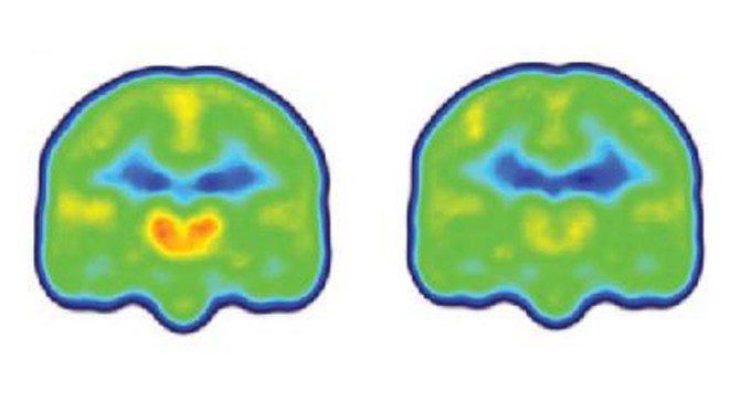 chronic pain protein builds up