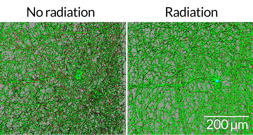 effects of radiation on the brain
