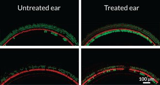 gene therapy restores sound-sensing cells