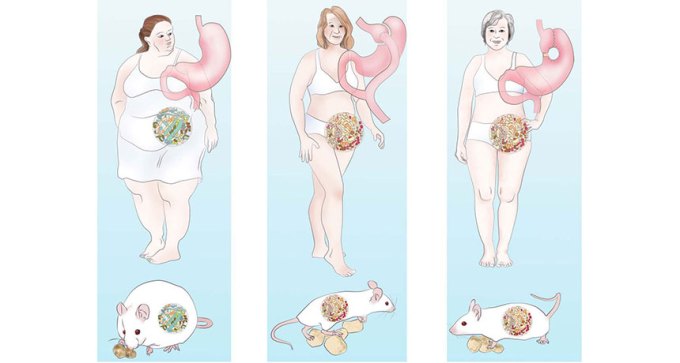illustration of different weight loss surgeries