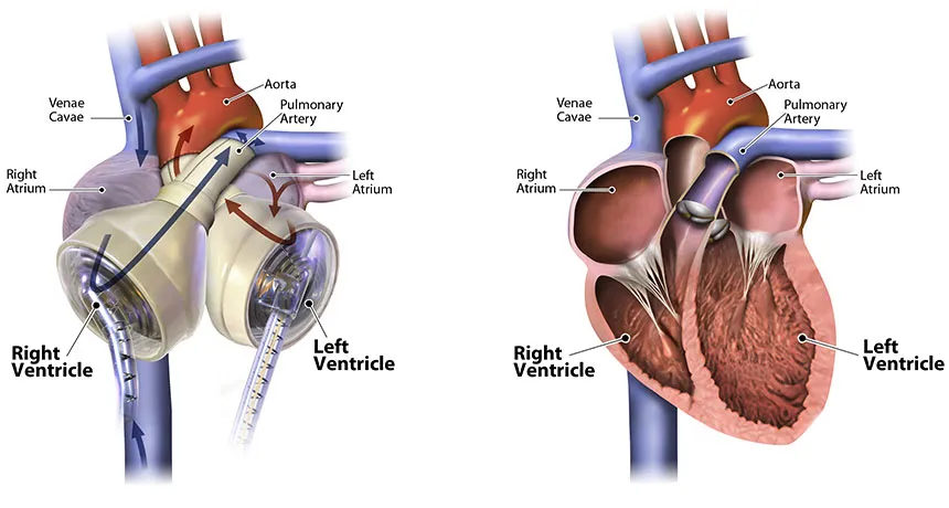 In 1965, hopes were high for artificial hearts