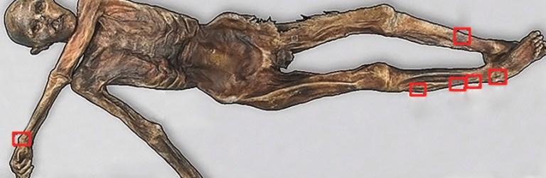 Ötzi the Iceman