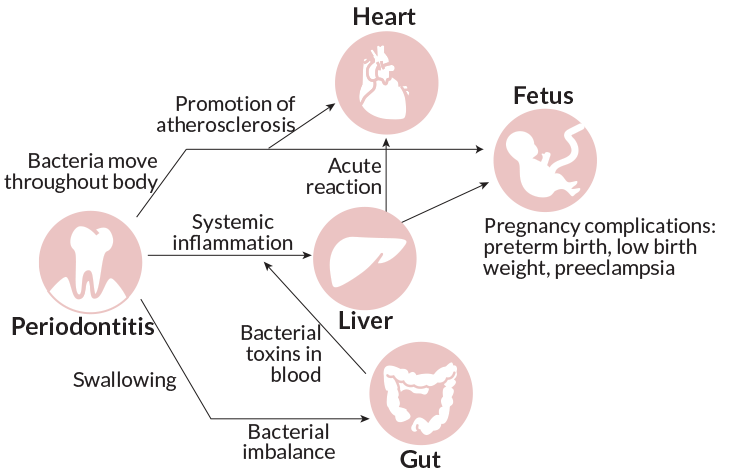 gum disease flow chart