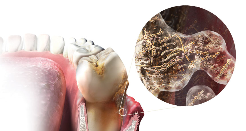 illustration of bacteria between teeth and gums