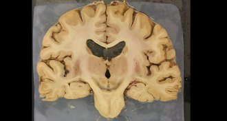 nerve cells affected by iron levels in the brain