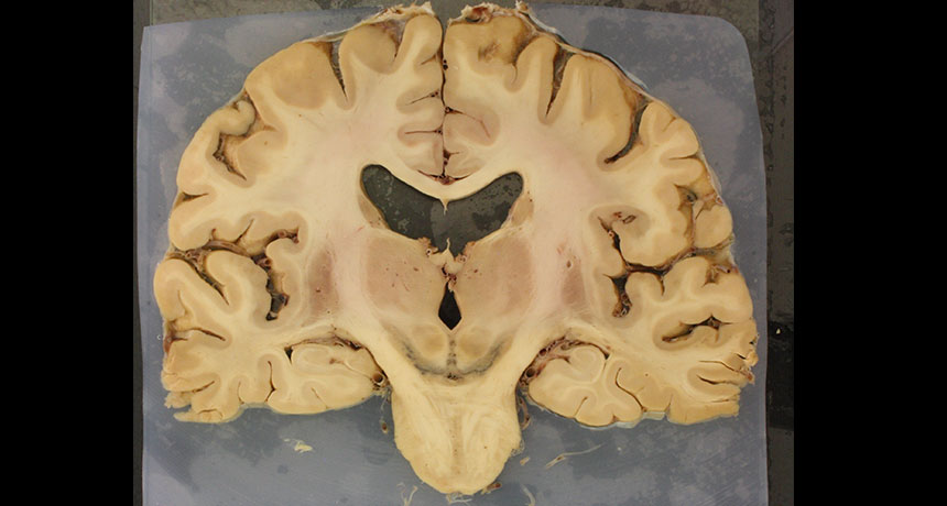 nerve cells affected by iron levels in the brain