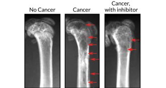 multiple myeloma in mouse bones