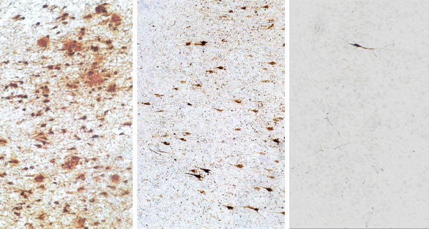 brain plaques and tangles