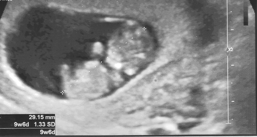 9 week ultrasound