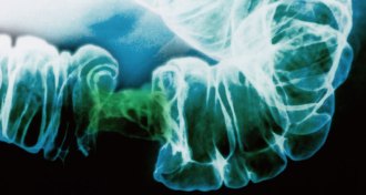 X-ray of colon tumor