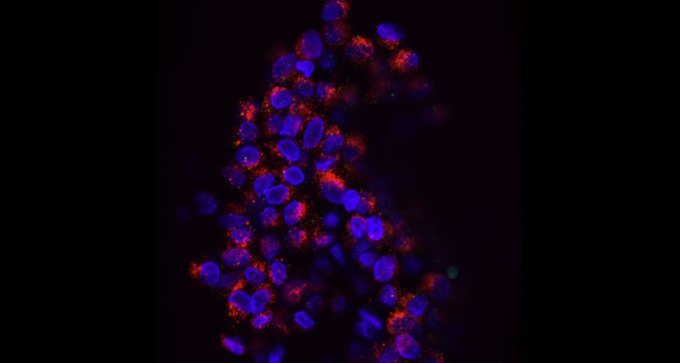 cluster of tumor cells