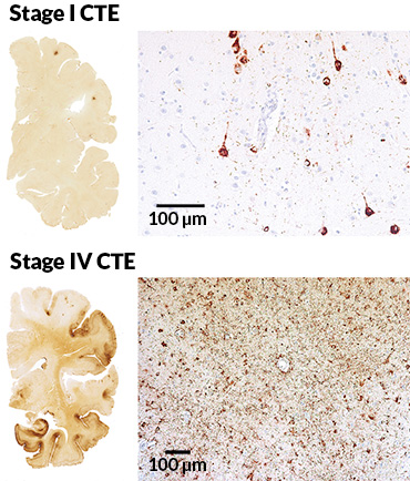 CTE histology slides