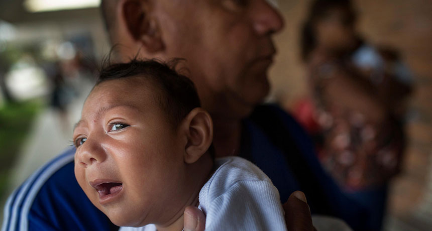 1-month-old baby with microcephaly