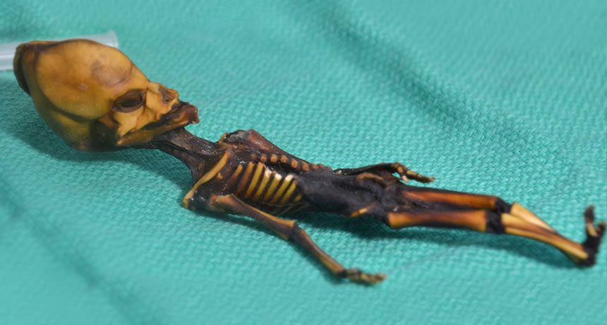 fetal mummy