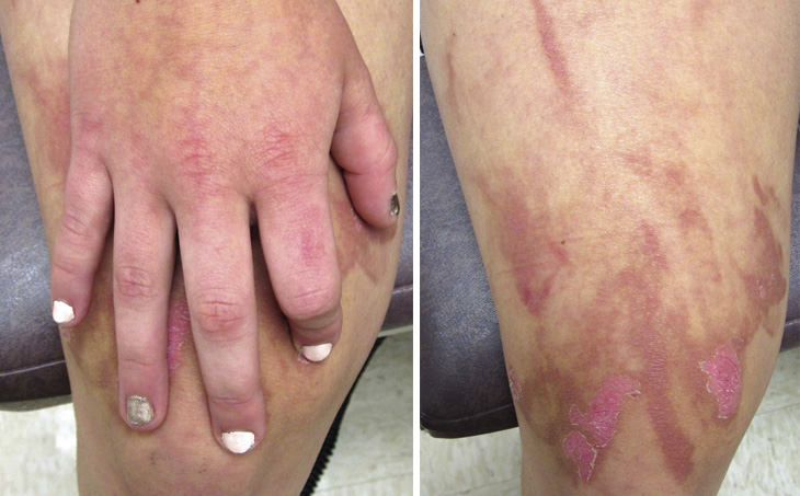 burns from lemon juice and sun exposure