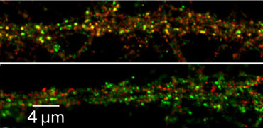 electron micrograph of an autoantibody attacking the AMPA receptor