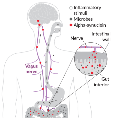 an illustration showing how an inflammatory reaction in the gut can cause nerve death in the brain