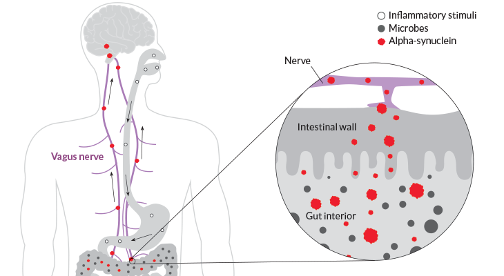 an illustration showing how an inflammatory reaction in the gut can cause nerve death in the brain