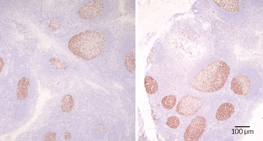 a microscopic image showing differences in immune structure in tonsils between kids with and without repeat strep throat infections
