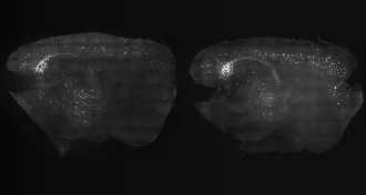 amyloid-beta plaques