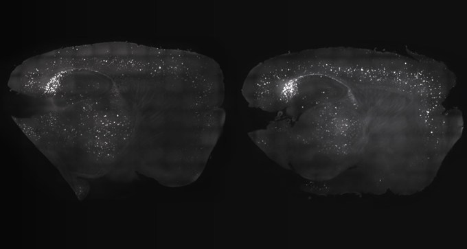 amyloid-beta plaques