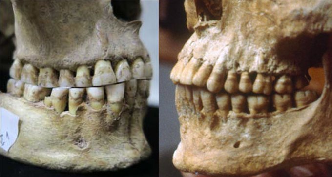 a composite photo of two skulls showing differences in overbites