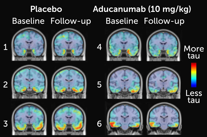 aducanumab treatment analysis