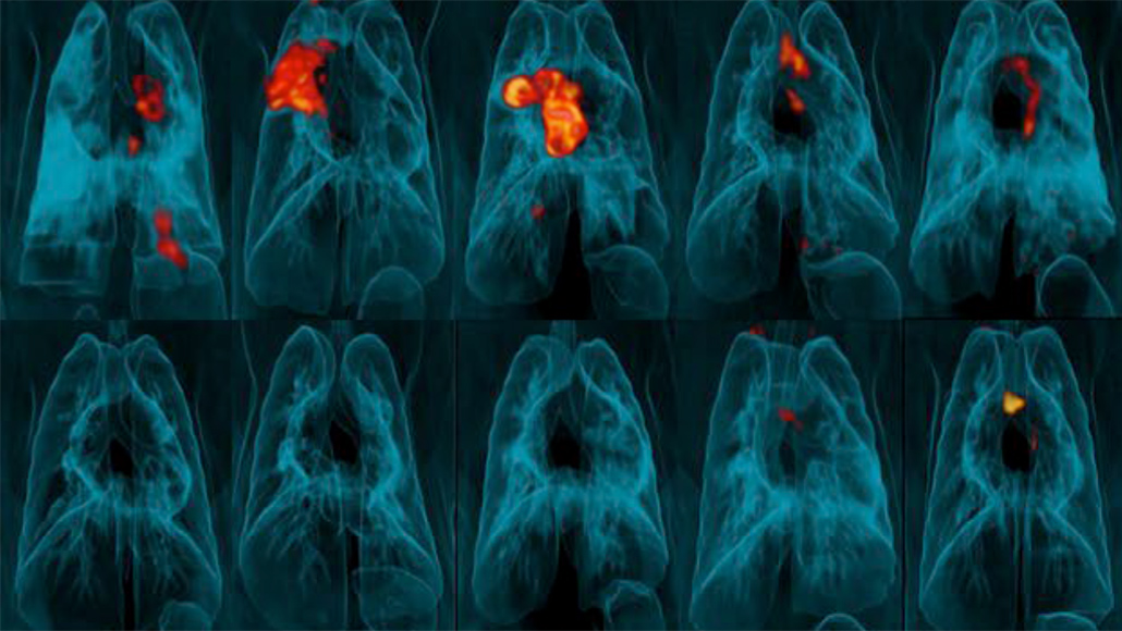lung scans