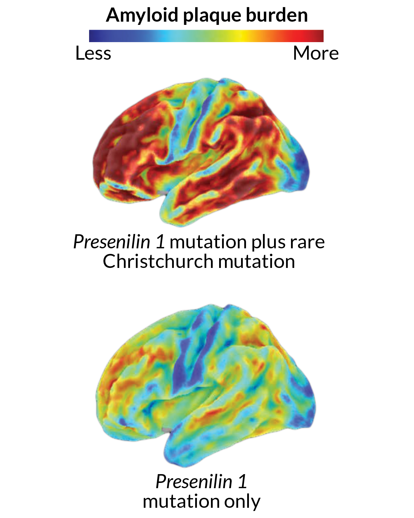 brains with amyloid plaques