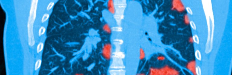 COVID-19 patient lung scan