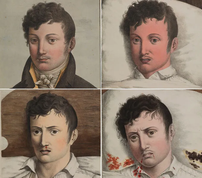 Yellow fever patient progresson