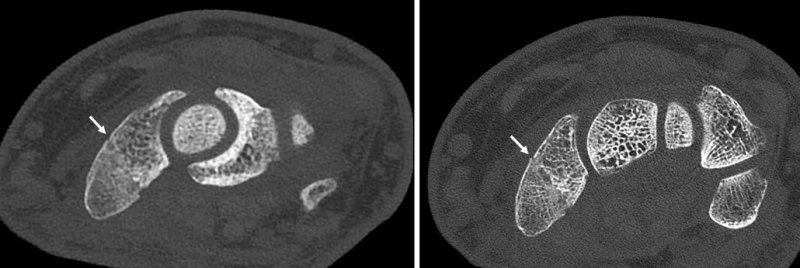 images of a broken wrist in a regular CT scan and a photo-counting CT scan