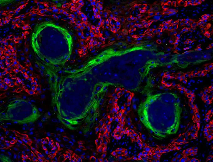 microscope image of a squamous cell carcinoma in a mouse