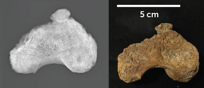 X-ray image of thigh bone fragment fused with kneecap and image of the fused bones