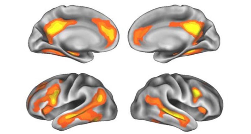 four views of the brain with regions that get smaller during pregnancy highlighted in yellow and orange
