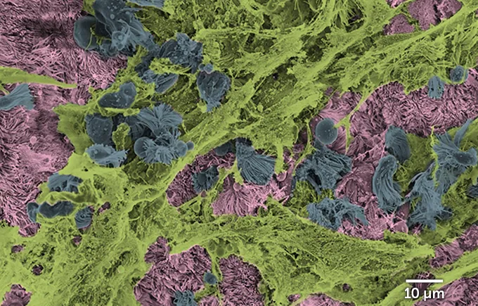 dying human airway-lining cells against healthy cells and covered in mucus