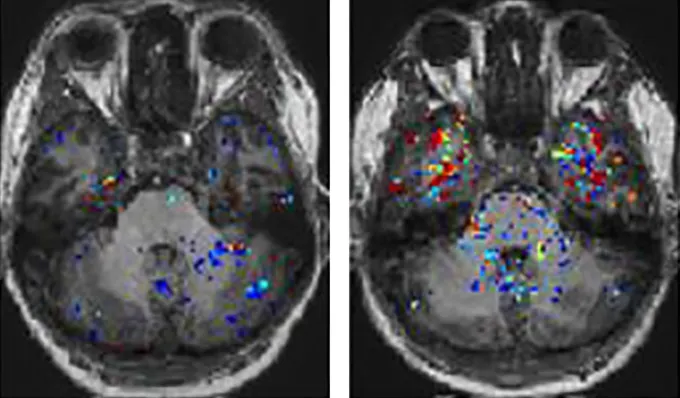 Side-by-side black and white brain scans. The scan on the left contains a few colored speckles. The scan on the right contains many more colored speckles.