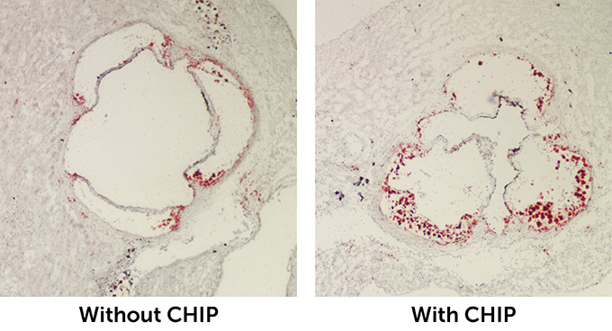 Two images showing the difference in size of fatty plaques in the aortas of mice with or without clonal hemaotpoiesis